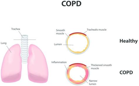 Copd : Doctors Reveal 10 Early Signs of COPD | 7 Minute Read - 251007-x