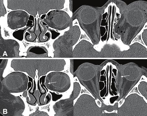 (A) Preoperative CT scan of the patient who has medial orbital wall... | Download Scientific Diagram