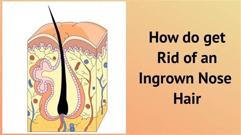 How do get Rid of an Ingrown Nose Hair - YouTube