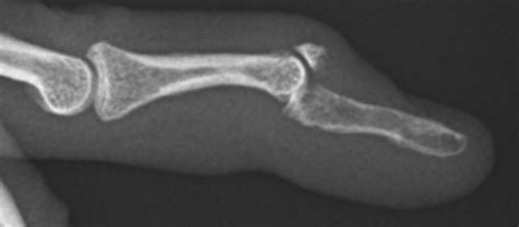 Image Gallery | Wrist & Hand Center - Dr. John M. Rayhack MD