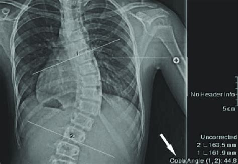 Cobb angle measurement done over the x-ray image [48]. | Download Scientific Diagram