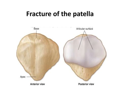 PPT - Fracture of the patella PowerPoint Presentation - ID:394804