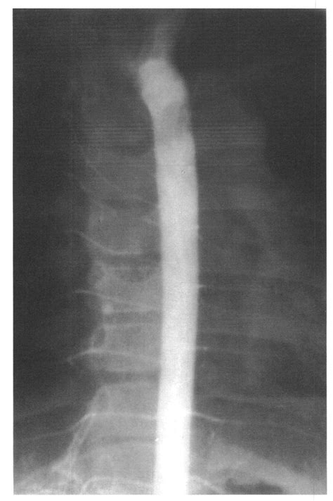 Aortogram in a patient with primary pulmonary hypertension. In spite... | Download Scientific ...