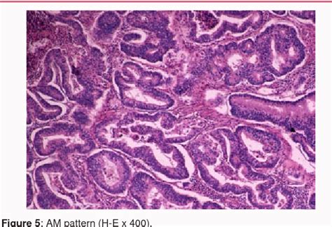 The Effect of Myometrial Invasion Pattern to Stage in Endometrial ...