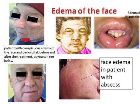 Periorbital Edema Nephrotic Syndrome