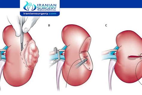 Kidney cancer treatment | Kidney tumor size chart | Iranian Surgery