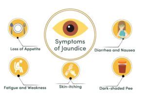 Jaundice: Causes, Symptoms & Treatment - Public Health Notes