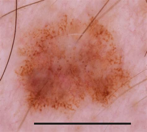 Dermoscopy of Melanocytic Neoplasms: Subpatterns of Dysplastic/Atypical Nevi | Dermatology ...