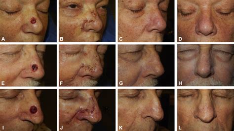 The superiorly based bilobed flap for nasal reconstruction - Journal of the American Academy of ...