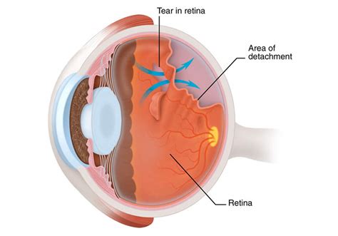 Retinal Detachment (Torn & Detached Retina) - Retina Eya Care, P.C.