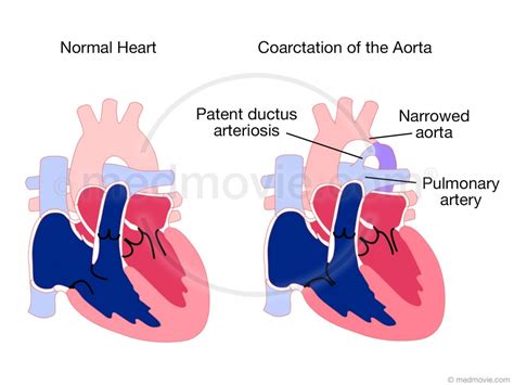 Coarctation of the Aorta – Medmovie.com