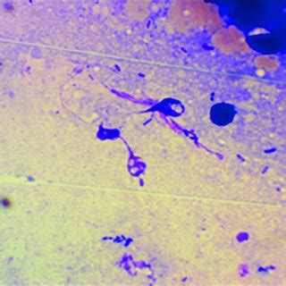 Neutrophil extracellular traps in the tumor center of a patient with... | Download Scientific ...