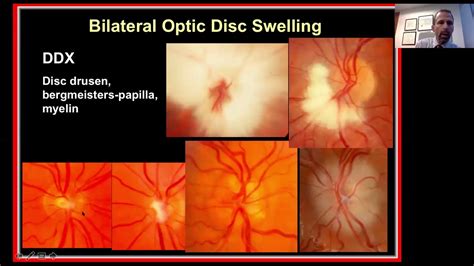 Con fecha de impaciente Tableta optic nerve edema causes Tercero Aprovechar oler