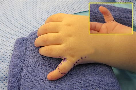 POLYDACTYLY | Hand Surgery Source