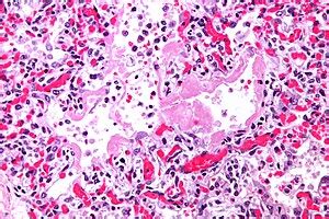 Diffuse alveolar damage - Libre Pathology