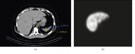 Figure 1 from Autosplenectomy in a Patient with Paroxysmal Nocturnal Hemoglobinuria (PNH ...