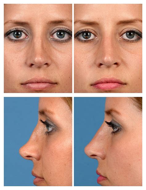 Liquid Rhinoplasty Before and After Pictures