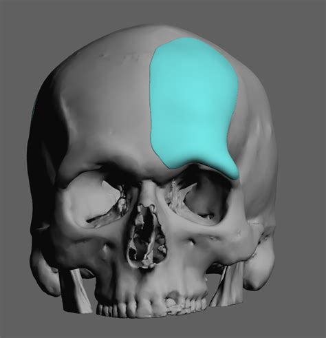 Plastic Surgery Case Study - Correction of Anterior Plagiocephaly with ...