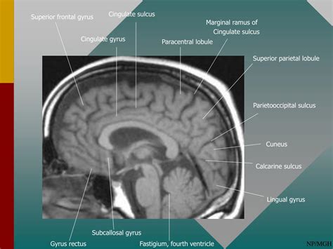 Mri Paracentral Lobule