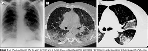 Bronchiolitis Obliterans Organizing Pneumonia | Semantic Scholar