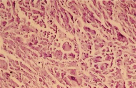 Photomicrograph fibrous histiocytoma. | Download Scientific Diagram