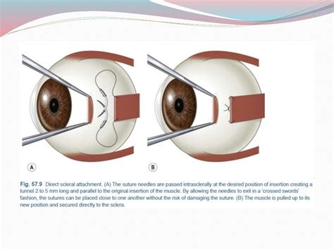 Principles of strabismus surgery