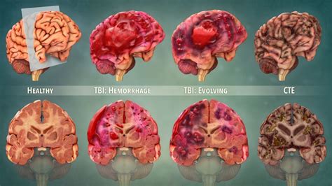 Cte Brain Compared To Normal Brain : Mri Of Truamatic Brain Injury By ...