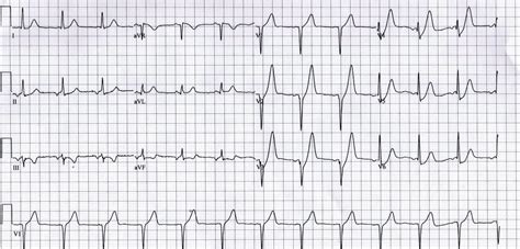 De Winter T Wave • LITFL • ECG Library Diagnosis