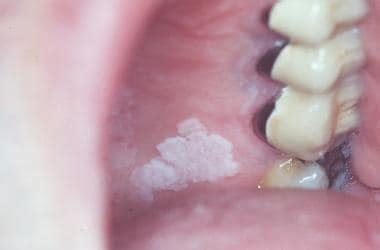 Idiopathic Leukoplakia