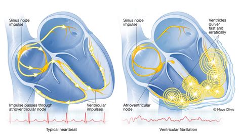 Ventricular Fibrillation Vs Atrial Fibrillation