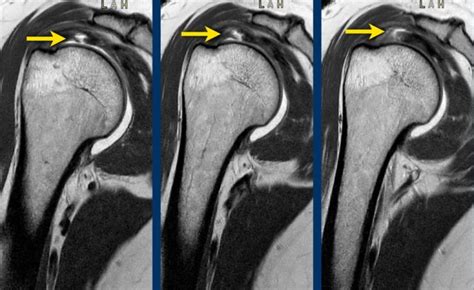 The Radiology Assistant : Shoulder - Rotator cuff injury