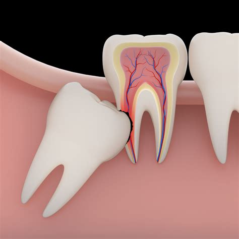 Impacted Wisdom Tooth Removal - Bolingbrook, IL - Extraction