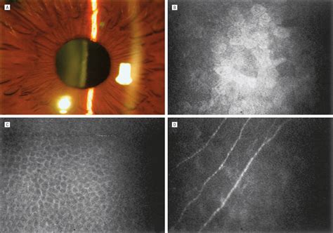 Treatment of Recurrent Corneal Erosion With Substance P–Derived Peptide and Insulin-like Growth ...