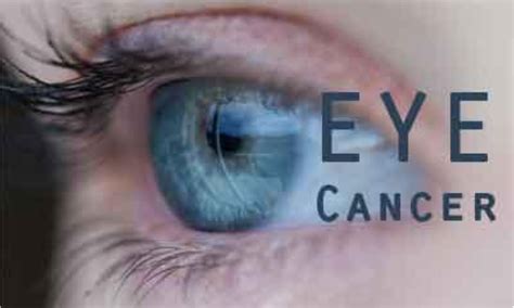 Kerala gets its first Department of Ocular Oncology for eye cancer ...