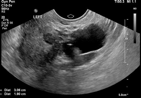 The tertiary ultrasound of the left adnexa demonstrating a 30 mm × 19 ...