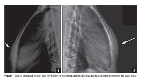 Broken Sternum X Ray