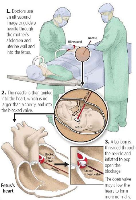 1981-On April 26, 1981, under the direction of Dr. Michael Harrison, the first human open fetal ...