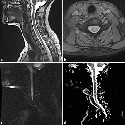 a T2-weighted sagittal MRI of the cervical spine. b T2-weighted axial... | Download Scientific ...