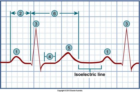 The ECG tracing as seen in normal sinus rhythm. 1, P wave; 2, PR interval; 3, QRS complex: Q ...