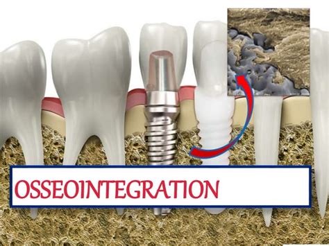 "OSSEOINTEGRATION" | PPT