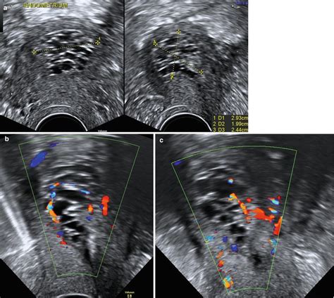 Ultrasound Evaluation of Endometrium | Obgyn Key