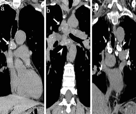 Mediastinal enlarged lymph nodes with calcification in TB and silicosis ...