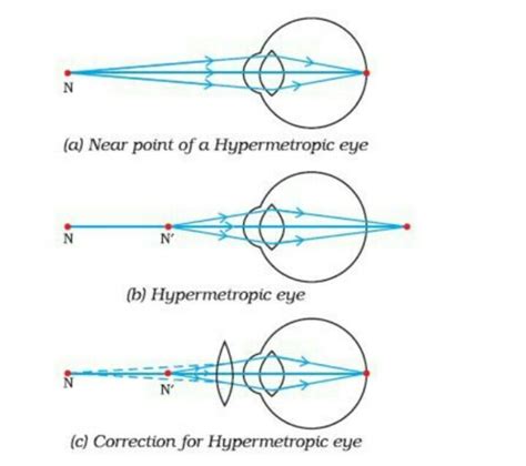 explain meaning causes correction of hypermetropia with ray diagrams - Brainly.in