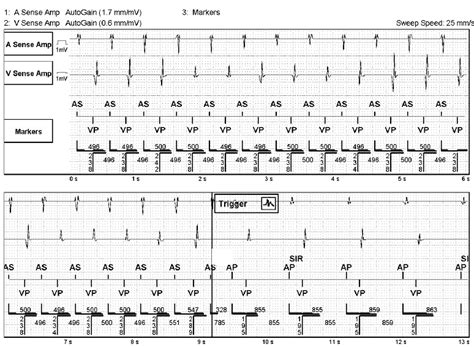 Case 3: An 82 Year-Old Man in the Pacemaker Clinic - ECG Made Simple