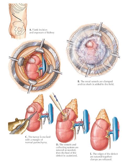 PARTIAL NEPHRECTOMY - pediagenosis