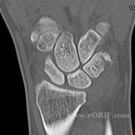 Triquetral Fracture S62.113A 814.03 | eORIF