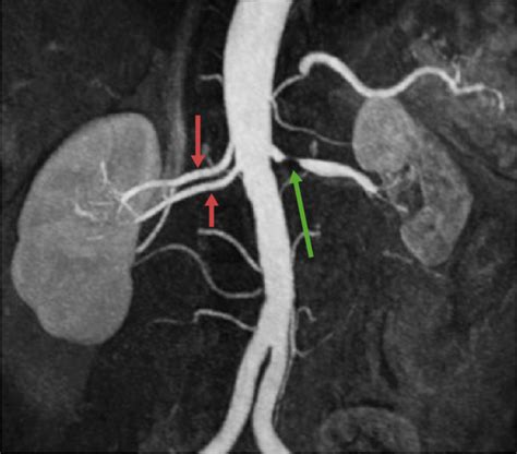 Renal Artery Stenosis | Concise Medical Knowledge