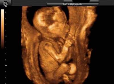 Your Ultrasound – Determining Baby Gender With 3D and 4D Ultrasound