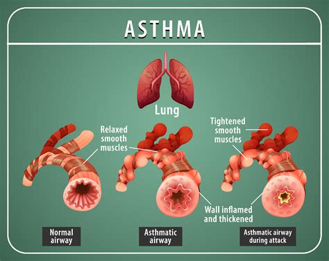 Asthma diagram with normal airway and asthmatic airway 3736238 Vector ...