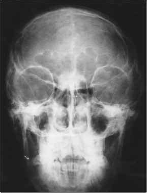 Orbital Hypertelorism - Syndrome Omim - RR School Of Nursing